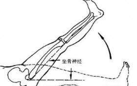 腰椎间盘突出症的自我疗法之坐骨神经痛的锻炼方法来了，快收藏！